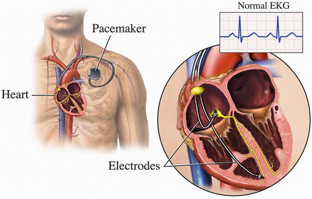 Pacemaker