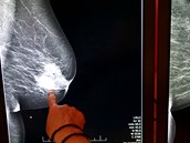 Diagnózu rakovina si v životě vyslechne každý třetí obyvatel České republiky a každý čtvrtý na ni zemře. Ale strašáka, který kdysi znamenal téměř jistou smrt, dnes lze mnohem úspěšněji léčit. U žen je nejčastější rakovina prsu. Diagnózu rakovina si v životě vyslechne každý třetí obyvatel České republiky a každý čtvrtý na ni zemře. Ale strašáka, který kdysi znamenal téměř jistou smrt, dnes lze mnohem úspěšněji léčit. U žen je nejčastější rakovina prsu.